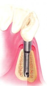 Foleck Dental Implant Image