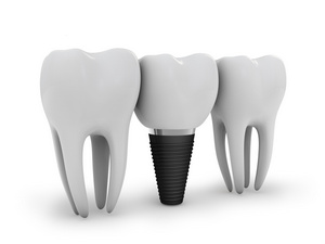 tooth decay and dental implants