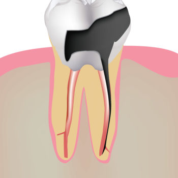 Tooth decay and dental implants