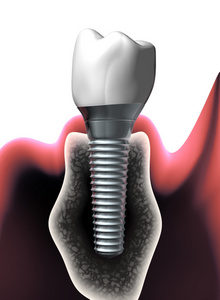 Dry mouth and dental implants